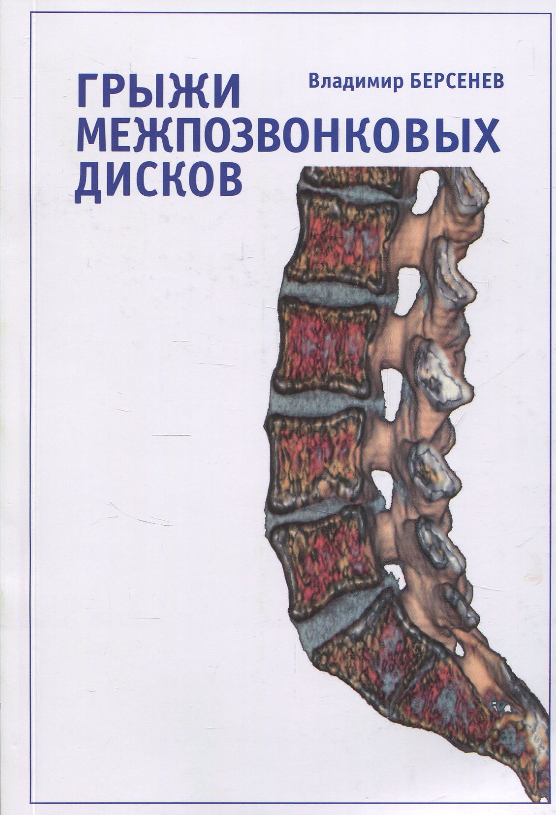 

Грыжи межпозвонковых дисков