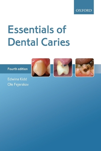 [object Object] «Essentials of Dental Caries», авторов Эдвина Кидд, Оле Фейерсков - фото №1