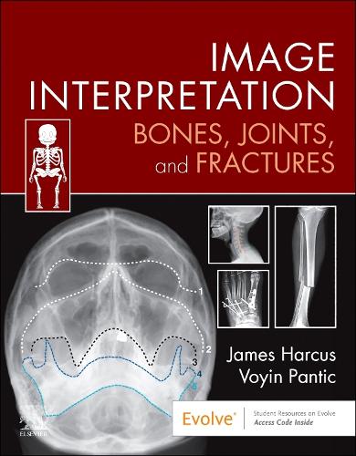 Бумажная книга «Image Interpretation: Bones, Joints, and Fractures», авторов Джеймс Харкус, Воин Пантич - фото №1