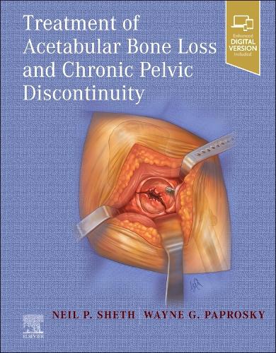 Бумажная книга «Treatment of Acetabular Bone Loss and Chronic Pelvic Discontinuity», авторов Нил П. Шет, Уэйн Папроски - фото №1