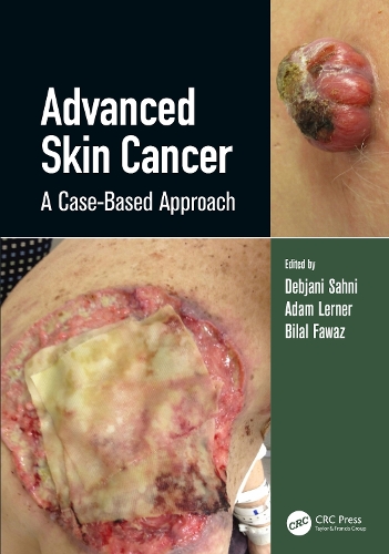 Паперова книга «Advanced Skin Cancer: A Case-Based Approach» - фото №1