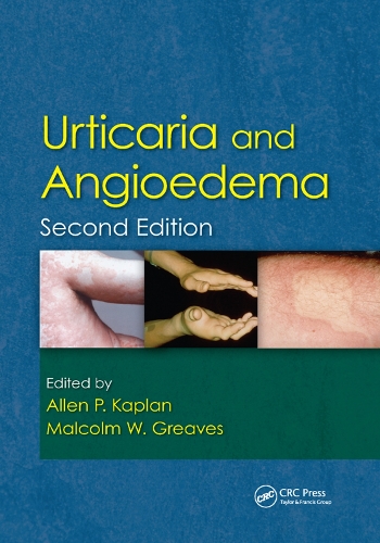 Бумажная книга «Urticaria and Angioedema» - фото №1