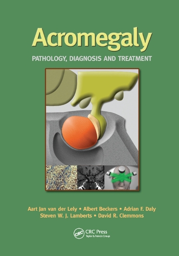 Паперова книга «Acromegaly: Pathology, Diagnosis and Treatment», авторів Аарт Ян ван дер Лелі, Адріан Дейлі, Альберт Бекерс, Девід Р. Клеммонс, Стівен В. Ламбертс - фото №1