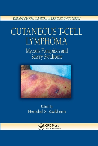 Бумажная книга «Cutaneous T-Cell Lymphoma: Mycosis Fungoides and Sezary Syndrome» - фото №1