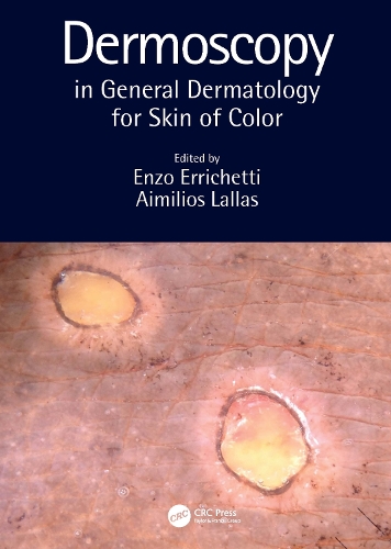 Паперова книга «Dermoscopy in General Dermatology for Skin of Color» - фото №1