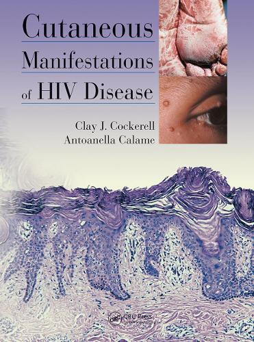 Паперова книга «Cutaneous Manifestations of HIV Disease», авторів Антоанелла Каламе, Клей Кокерелл - фото №1