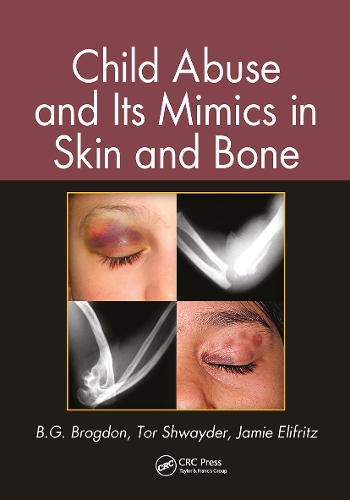 Бумажная книга «Child Abuse and its Mimics in Skin and Bone», авторов B. Г. Брогдон, Джейми Элифриц, Тор Швайдер - фото №1