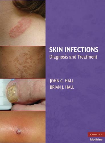 Паперова книга «Skin Infections: Diagnosis and Treatment», автор Брайан Дж. Холл - фото №1