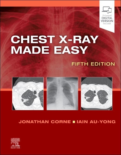 Бумажная книга «Chest X-Ray Made Easy», авторов Иэн Ау-Йонг, Джонатан Корн - фото №1