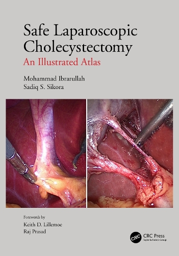 Бумажная книга «Safe Laparoscopic Cholecystectomy: An Illustrated Atlas», авторов Мохаммад Ибрарулла, Садик С. Сикора - фото №1
