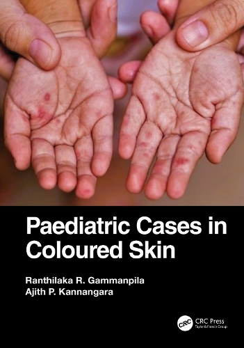Паперова книга «Paediatric Cases in Coloured Skin», авторів Аджит П. Каннангара, Рантілака Р. Гамманпіла - фото №1