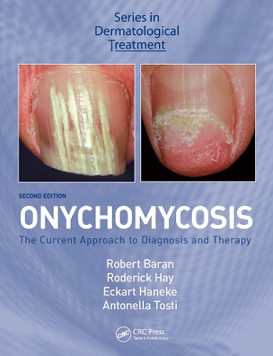Паперова книга «Onychomycosis: The Current Approach to Diagnosis and Therapy» - фото №1