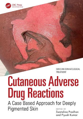 Паперова книга «Cutaneous Adverse Drug Reactions: A Case Based Approach for Deeply Pigmented Skin» - фото №1