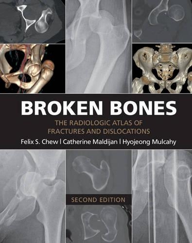 Бумажная книга «Broken Bones: The Radiologic Atlas of Fractures and Dislocations», авторов Кэтрин Малдиджан, Хёчжон Малкахи - фото №1
