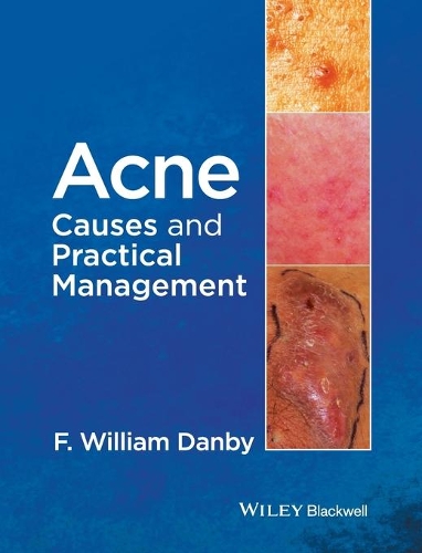 Паперова книга «Acne: Causes and Practical Management», автор Ф. Вільям Денбі - фото №1