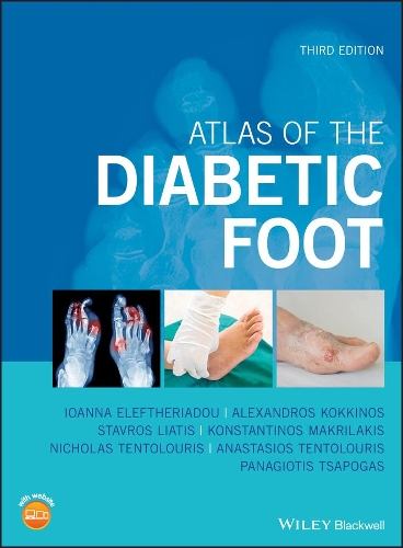 Паперова книга «Atlas of the Diabetic Foot», авторів Александрос Коккінос, Анастасіос Тентолуріс, Іоанна Елефтеріаду, Константінос Макрілакіс, Ніколас Тентолуріс, Панагіотіс Цапогас, Ставрос Ліатіс - фото №1