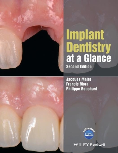 Бумажная книга «Implant Dentistry at a Glance», авторов Фрэнсис Мора, Жак Мале, Филипп Бушар - фото №1