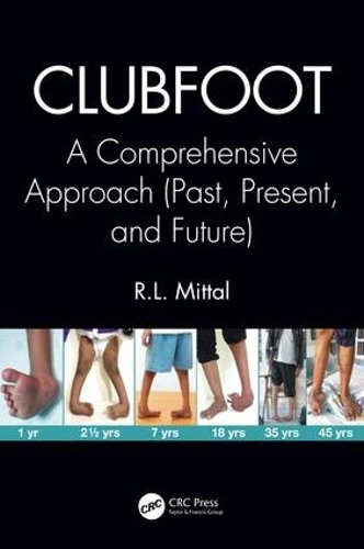 Бумажная книга «Clubfoot: A Comprehensive Approach (Past, Present, and Future)», автор Р. Л. Миттал - фото №1