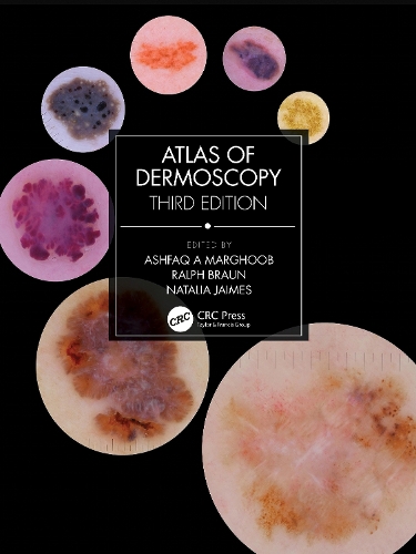 [object Object] «Atlas of Dermoscopy: Third Edition», авторов Ашфак А Маргуб, Наталья Хаймес - фото №1