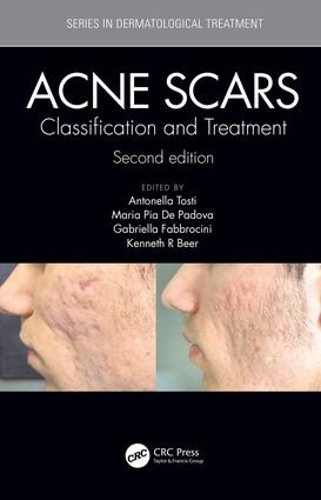 Бумажная книга «Acne Scars: Classification and Treatment, Second Edition» - фото №1