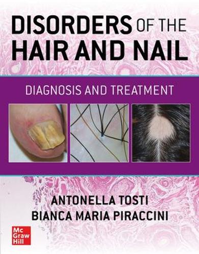 Паперова книга «Disorders of the Hair and Nail: Diagnosis and Treatment», авторів Антонелла Тості, Бьянка Марія Пірачіні - фото №1