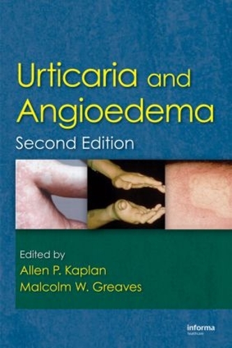 Бумажная книга «Urticaria and Angioedema» - фото №1