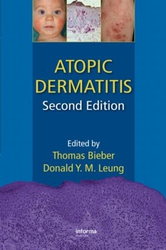 Бумажная книга «Atopic Dermatitis» - фото №1