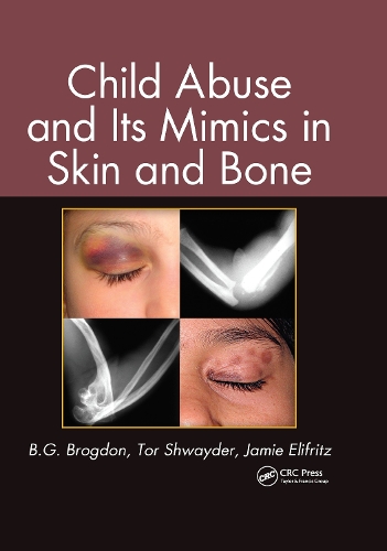 Паперова книга «Child Abuse and its Mimics in Skin and Bone», авторів B. Г. Брогдон, Джеймі Еліфріц, Тор Швайдер - фото №1