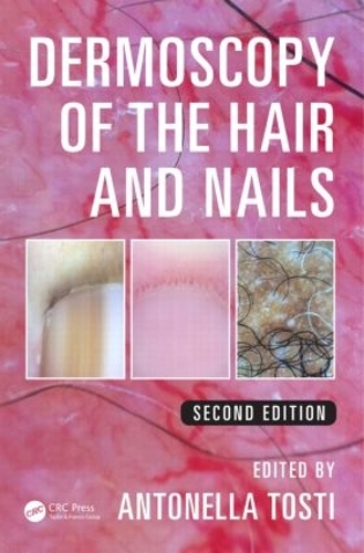 Бумажная книга «Dermoscopy of the Hair and Nails», автор Антонелла Тости - фото №1