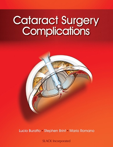 Бумажная книга «Cataract Surgery Complications», автор Марио Романо - фото №1