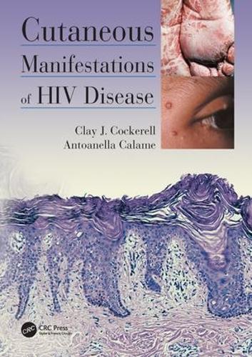 Паперова книга «Cutaneous Manifestations of HIV Disease», авторів Антоанелла Каламе, Клей Кокерелл - фото №1
