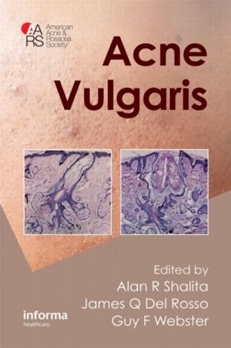 Бумажная книга «Acne Vulgaris» - фото №1