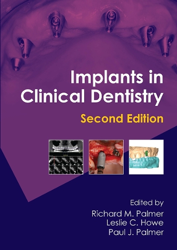 Паперова книга «Implants in Clinical Dentistry», авторів Леслі К. Хоу, Пол Дж. Палмер, Річард М. Палмер - фото №1