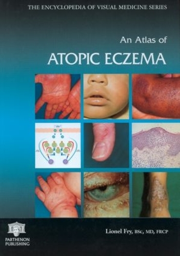Бумажная книга «An Atlas of Atopic Eczema», автор Лайонел Фрай - фото №1