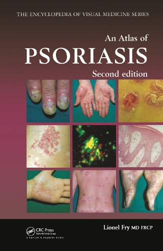 Бумажная книга «An Atlas of Psoriasis, Second Edition», автор Лайонел Фрай - фото №1