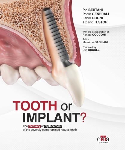 Паперова книга «Tooth or Implant», авторів Фабіо Горні, Паоло Дженералі, Тіціано Тесторі - фото №1