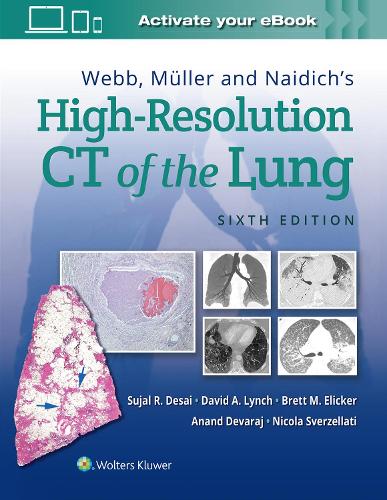 Паперова книга «Webb, Müller and Naidich's High-Resolution CT of the Lung», авторів Ананд Деварадж, Бретт М. Елікер, Девід Лінч, Нікола Сверзеллаті, Суджал Десаї - фото №1