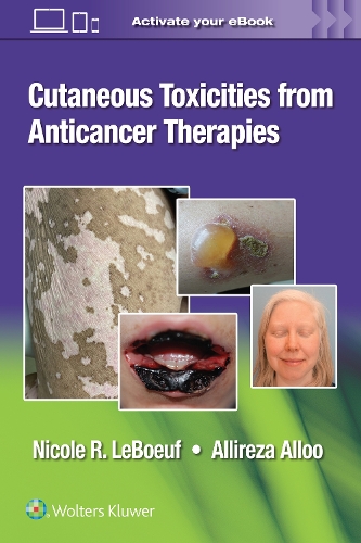 Бумажная книга «Cutaneous Toxicities from Anticancer Therapies», авторов Аллиреза Аллоо, Николь ЛеБоф - фото №1