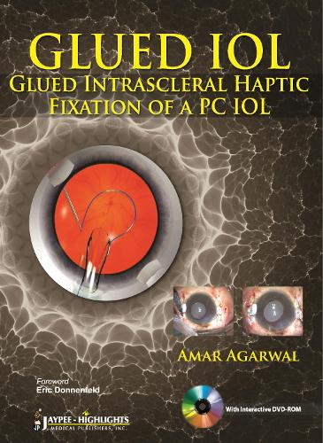 Бумажная книга «GLUED IOL: Glued Intrascleral Haptic Fixation of a PC IOL», автор Амар Агарвал - фото №1