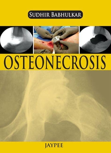 Бумажная книга «Osteonecrosis», автор Судхир Бабхулкар - фото №1