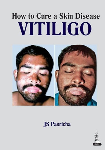Бумажная книга «How to Cure a Skin Disease: Vitiligo», автор Дж. С. Пасрича - фото №1