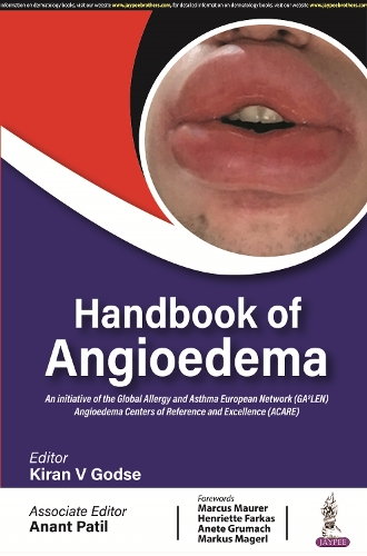 Бумажная книга «Handbook of Angioedema», авторов Анант Патил, Киран В Годсе - фото №1