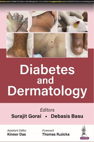 Паперова книга «Diabetes and Dermatology», авторів Дебасіш Басу, Кіннор Дас, Сураджіт Горай - фото №1